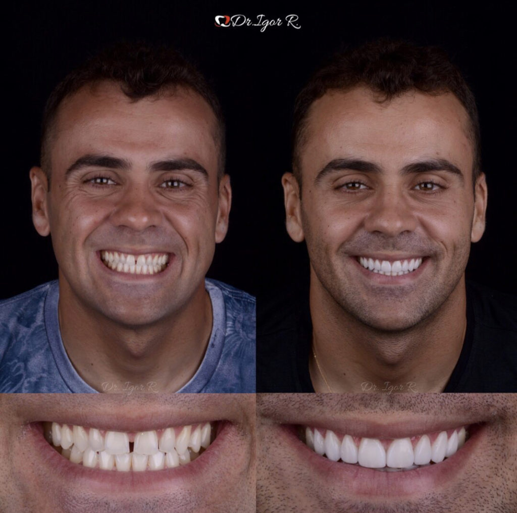 Exemplo de "antes e depois" de lentes de contato dentais