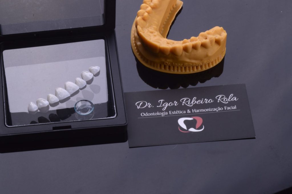 Lentes de contato dentais usadas nos procedimentos do Dr. Igor Ribeiro