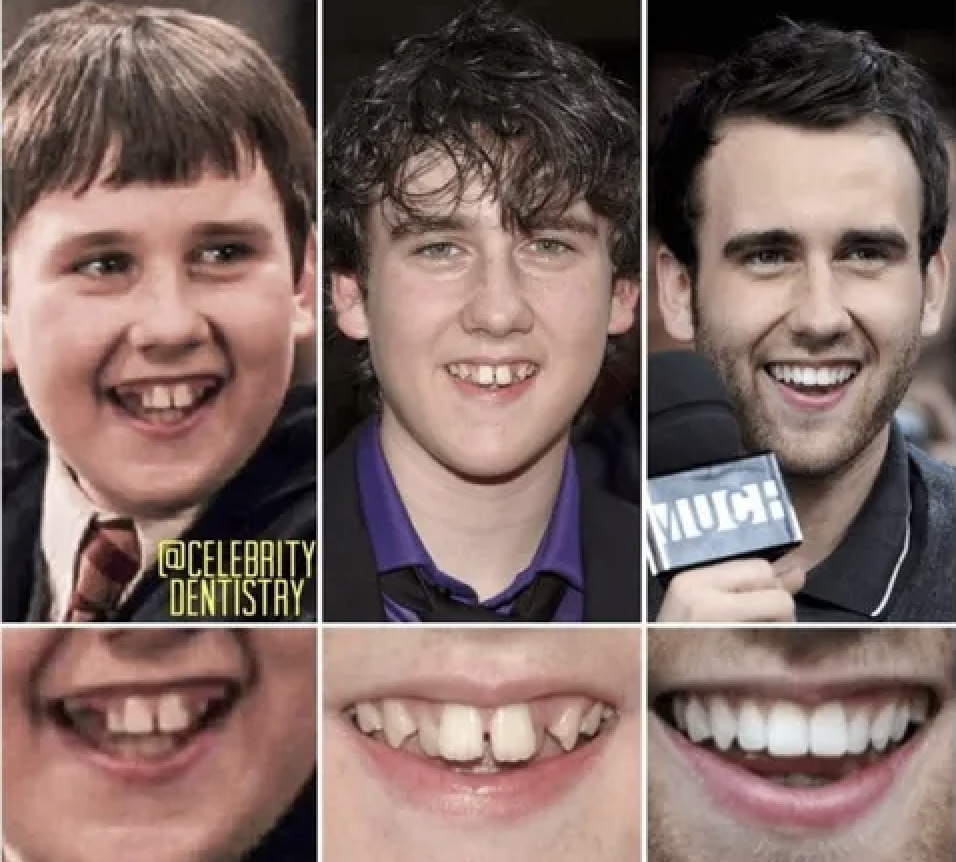 Antes e depois do sorriso de Matthew Lewis