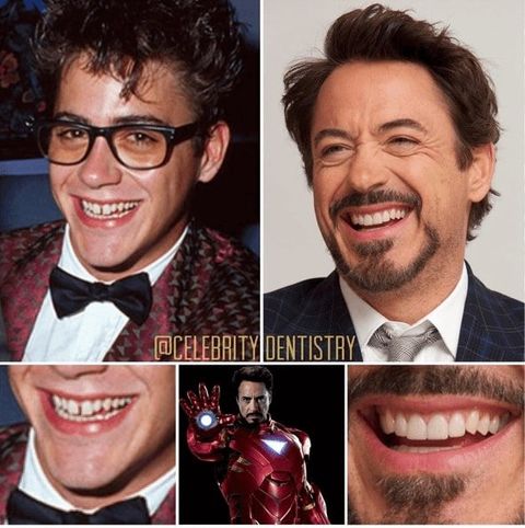 Antes e depois do sorriso de Robert Downey Jr.