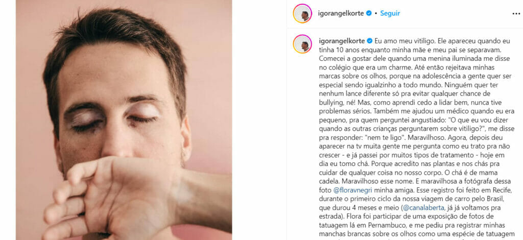 Igor Angelkort sofre o vitiligo